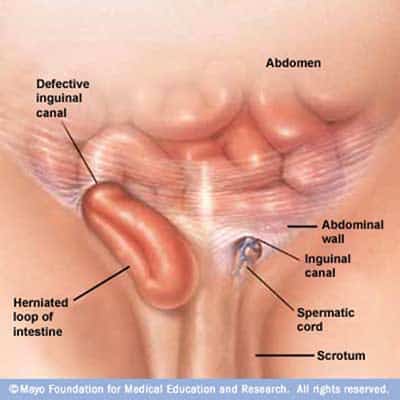 Picture of Inguinal Hernia