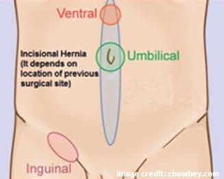 Picture of different hernia types