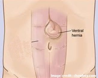 Picture of Ventral Hernia